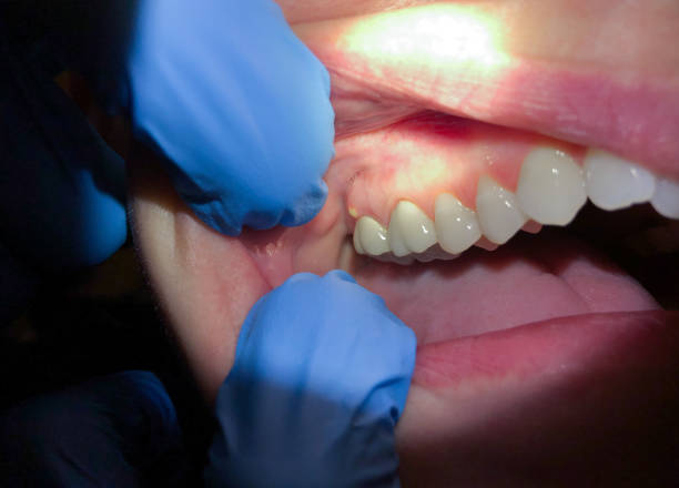 Best Broken or Cracked Tooth Emergency Dentist in Pikesville, MD